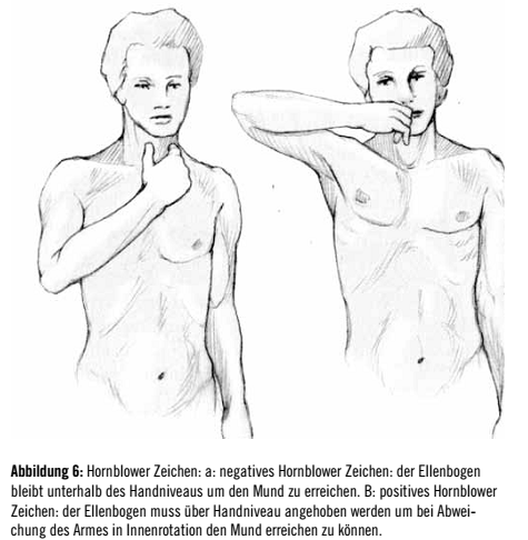 Abbildung 6: Hornblower Zeichen: a: negatives Hornblower Zeichen: der Ellenbogen bleibt unterhalb des Handniveaus um den Mund zu erreichen. B: positives Hornblower Zeichen: der Ellenbogen muss über Handniveau angehoben werden um bei Abweichung des Armes in Innenrotation den Mund erreichen zu können. 