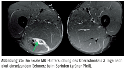 Abbildung 2b: Die axiale MRT-Untersuchung des Oberschenkels 3 Tage nach akut einsetzendem Schmerz beim Sprinten (grüner Pfeil). 
