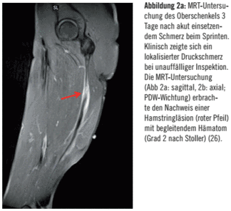 Abbildung 2a:MRT-Untersuchung des Oberschenkels 3 Tage nach akut einsetzendem Schmerz beim Sprinten. Klinisch zeigte sich ein lokalisierter Druckschmerz bei unauffälliger Inspektion. Die MRT-Untersuchung (Abb 2a: sagittal, 2b: axial; PDW-Wichtung) erbrachte den Nachweis einer Hamstringläsion (roter Pfeil) mit begleitendem Hämatom