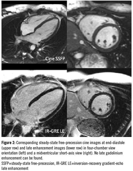 figure 2:Corresponding steady-state free-precession cine images at end-diastole (upper row) and late enhancement images (lower row) in four-chamber view orientation (left) and a midventricular short-axis view (right). No late gadolinium enhancement can be found. SSFP=steady-state free-precession, IR-GRE LE=inversion-recovery gradient-echo late enhancement